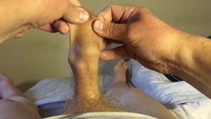 Foreskin Filled With 23 Marbles Plus Plastic Ball